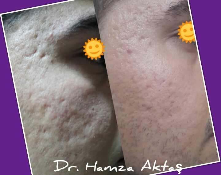 LAZER ( CİLT YENİLEME )